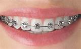 Pictures of Braces Colors Silver