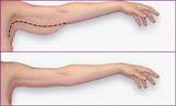 Pictures of Arm Workouts Before And After
