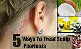 Scalp Psoriasis Diet Treatment