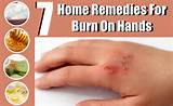 Pictures of Steam Burn Home Remedies