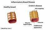 Crohn''s Disease Gas Problems Photos
