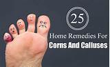 Best Treatment For Corns And Calluses