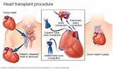 Images of Exercise Program Heart Surgery