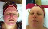Pictures of Light Therapy For Skin Conditions