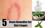 Pictures of Chikungunya Rash Home Remedies