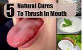 Mouth Infection Home Remedies Pictures