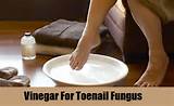 Vinegar Home Remedies For Toe Fungus Pictures