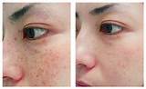 How To Get Rid Of Freckles Laser Treatment Pictures