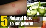 Ringworms Home Remedies