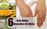 Chronic Hives Home Remedies