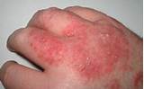 Eczema Treatment During Pregnancy Pictures