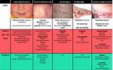 Pictures of Itp Treatment In Adults