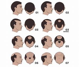  Pattern Hair Loss Lifestyle Pharmacy