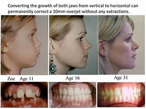 mewing change your face shape using just your tongue really