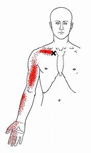 Subclavius The Trigger Point Referred Guide