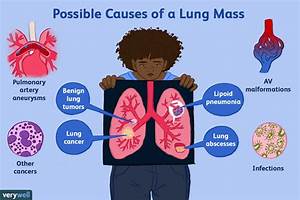 Causes Possibles D 39 Une Masse Pulmonaire