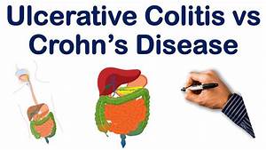 Ulcerative Colitis Vs Crohn 39 S Disease Part 1 Step Nclex Comlex Youtube