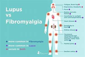 Fibromyalgia Vs Lupus What 39 S The Difference In 2021 Diagnosing