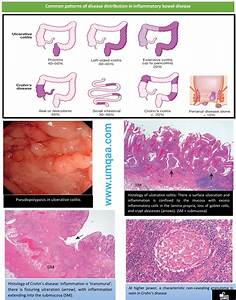 What Are The Differences Between Crohn 39 S Disease Cd And Ulcerative