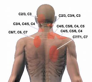 Cloward Sign Cervical Referral Patterns Modern Manual Therapy Blog