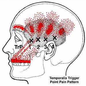 Is Your Tmj Jaw Causing Your Headache