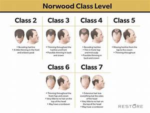 Norwood Scale For Balding Norwood Chart Restore Hair