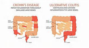 Ulcerative Colitis Uc Causes Symptoms Types Diagnosis Treatment