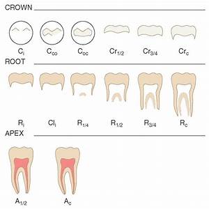 Complete Calcification Of Permanent Teeth Teeth Bonding