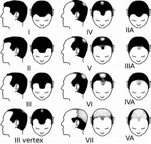 The Norwood Scale Hair Shedding Classification Stages 1 7