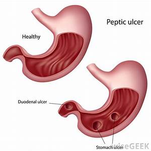 Duodenal Ulcer Diagram