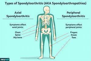 How Are Axial Spondyloarthritis And Ankylosing Spondylitis Related