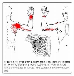 Can Myofascial Trigger Points Cause Shoulder Can Myofascial