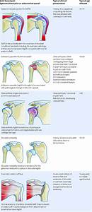 Shoulder Tendons Chart Assessment Of Shoulder For Non