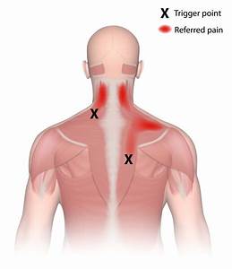 Les Trigger Points Physiomos
