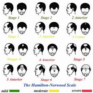 Norwood Scale For Judging Loss Related To Androgenetic Alopecia 