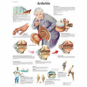 3b Scientific Arthritis Chart