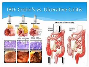 Ppt Nutritional Management Of Crohn S Disease Powerpoint Presentation