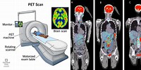 Resolution of Pet Scan