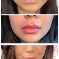 Thin Lips Before After