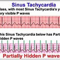 Atrial Flutter vs