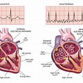 Ventricular Pacemaker