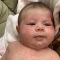 Baby Heat Rash Sure at Face