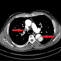 Aortic Dissection