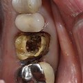 Dental Crown Core Build Up