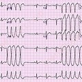 Nonsustained Ventricular