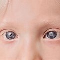 Albinism Eyes