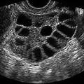 Ovaries Ultrasound