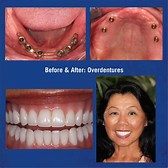 Denture Implants