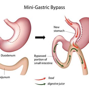 antibypass