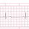 Bradycardia EKG Strip